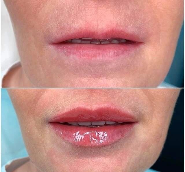 Asymmetrical Lip
